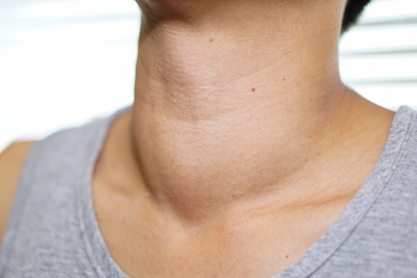 Homeopathic Approach to Goiter: Understanding and Healing Naturally
